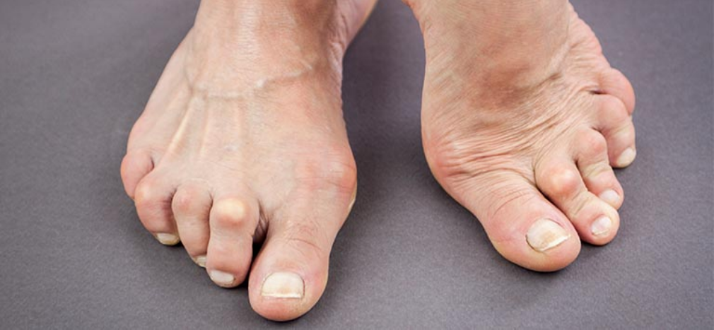 Hammertoes: What It Is, Causes, Relief & Treatment